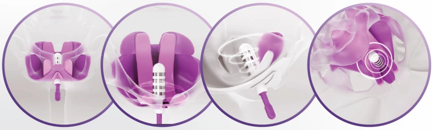 Elektrostymulacja przezpochwowa