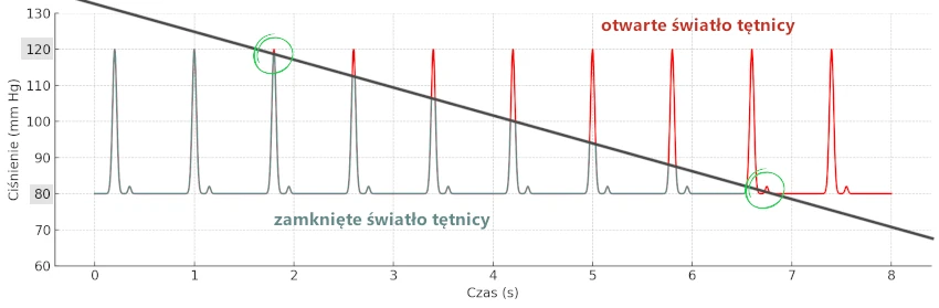 Zjawisko okluzji tętnicy