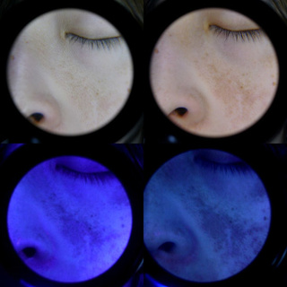 Lupa dermatologiczna ILLUCO IDS-3100 MAGNUM+ UV